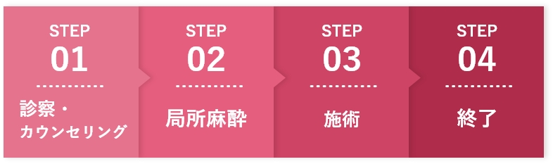 STEP1:診察・ カウンセリング、STEP2:局所麻酔、STEP3:施術、STEP4:終了