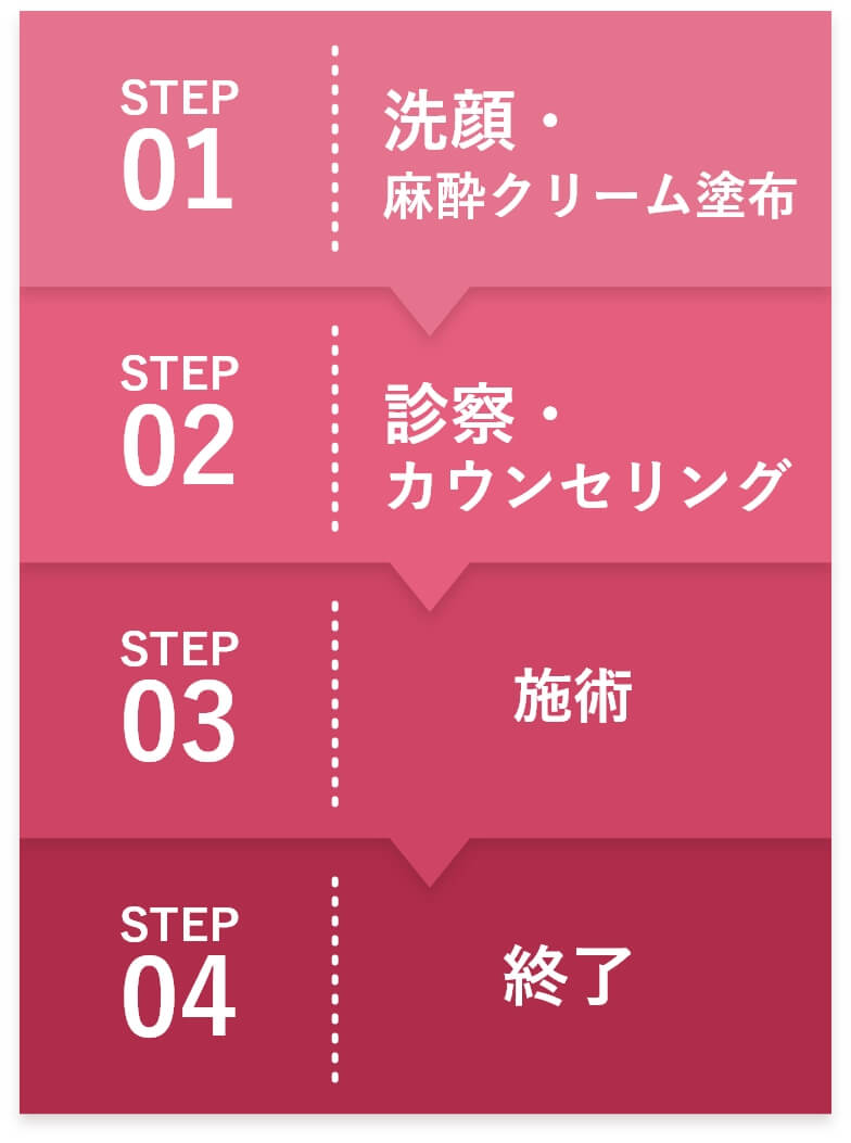 STEP1:診察・ カウンセリング、STEP2:局所麻酔、STEP3:施術、STEP4:終了