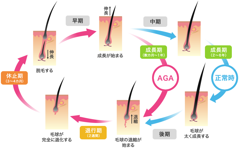 AGAと正常時のサイクル違い